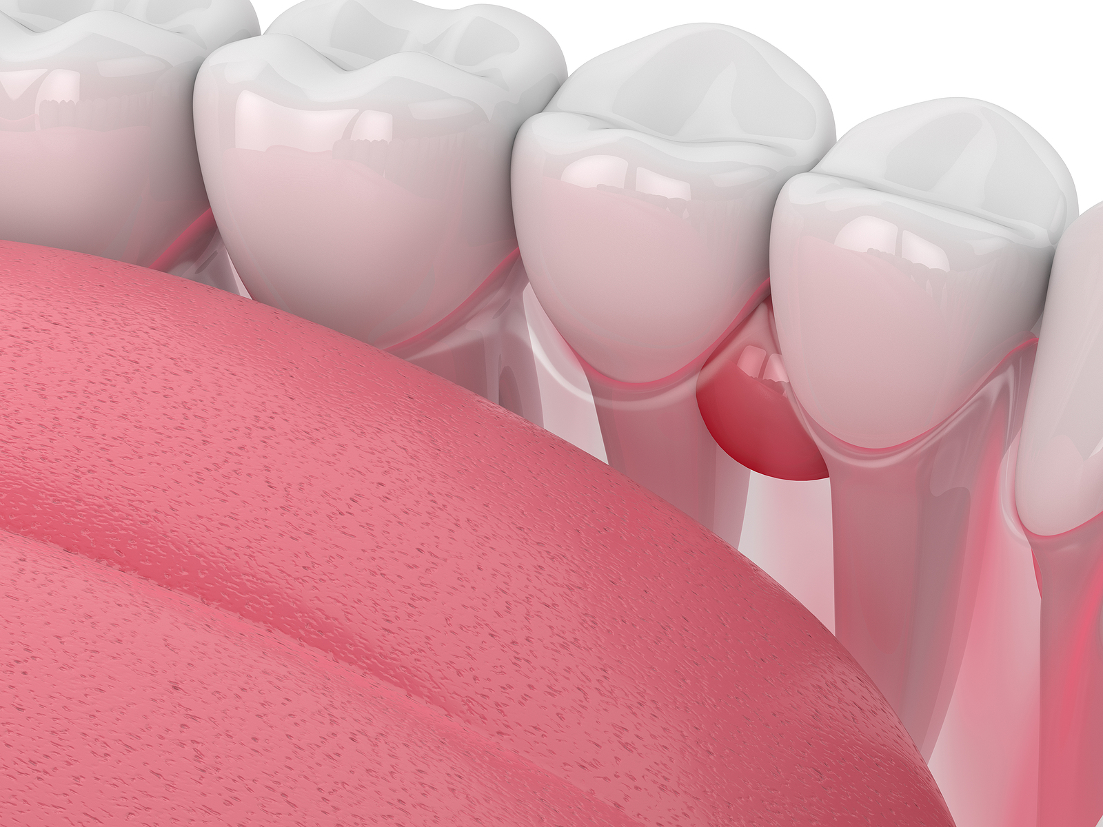 علائم و درمان فوری کیست دندان، لثه، دهان و ریشه دندان - دکتر سید احمد رضا هاشمی