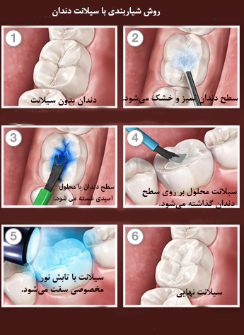مراحل فیشور سیلانت دندان