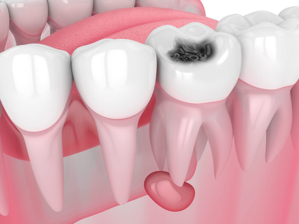 Tooth cyst کیست دندان