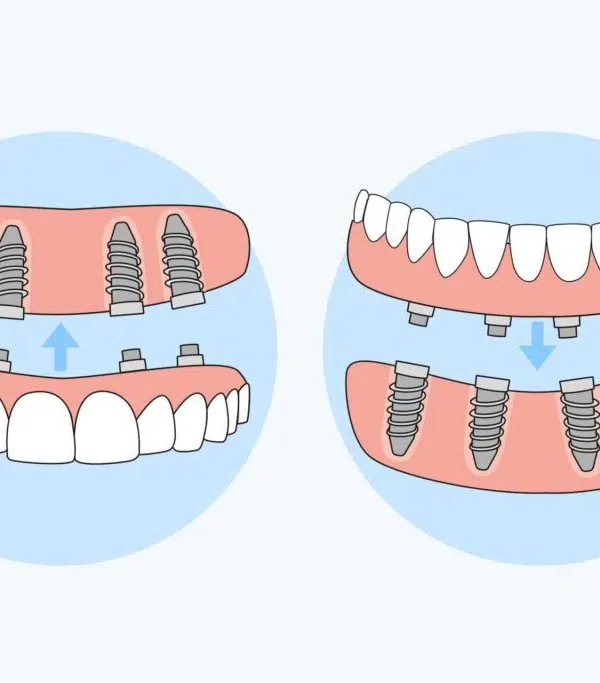 ایمپلنت ثابت دندان چیست
